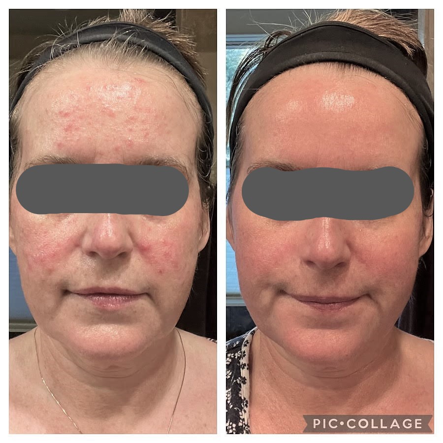 Before and After Rosacea